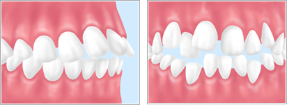 歯並びが気になる