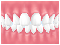 すきっ歯が気になる